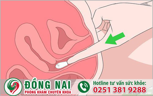 Các lưu ý cần biết khi áp dụng thuốc đặt viêm phụ khoa?