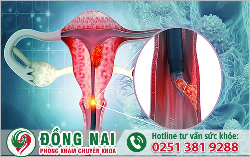 Nguyên nhân dẫn đến ung thư cổ tử cung ở nữ giới